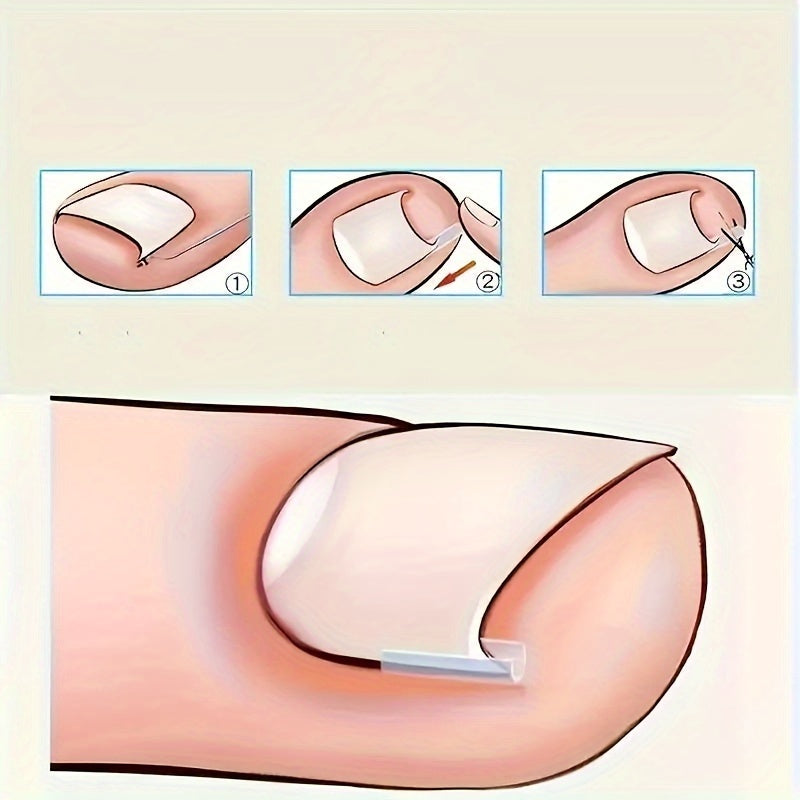 [Ingrown Toenail Kit] Ingrown Toenail Kit - 10/20/30/40/50/60/70/80/90/100pcs of Foot Tools and Foot Tools