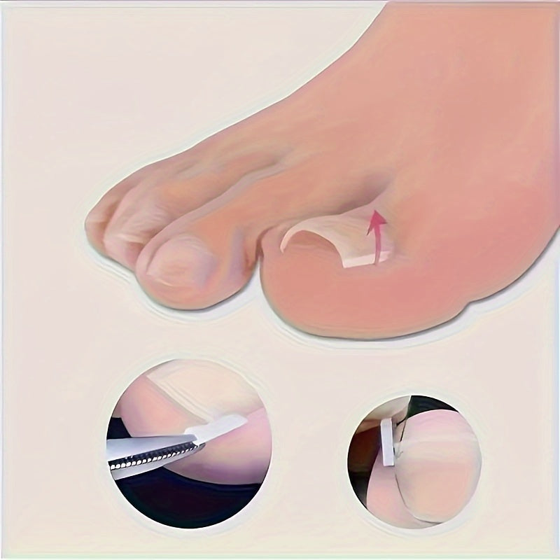 [Ingrown Toenail Kit] Ingrown Toenail Kit - 10/20/30/40/50/60/70/80/90/100pcs of Foot Tools and Foot Tools